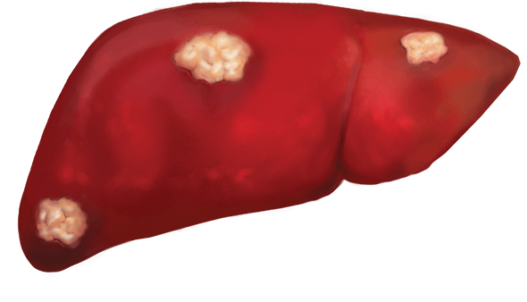 慢性乙肝是肝癌的主要病因
